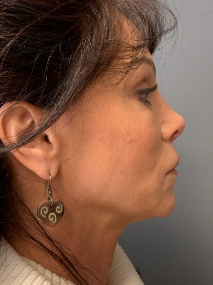 Deep Plane Facelift Before & After Patient #6049