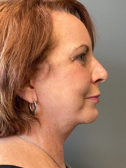 Deep Plane Facelift Before & After Patient #6056