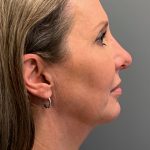 Deep Plane Neck Lift Before & After Patient #6119