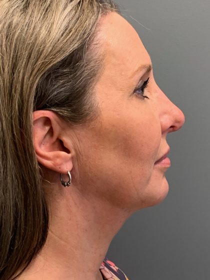 Deep Plane Neck Lift Before & After Patient #6119