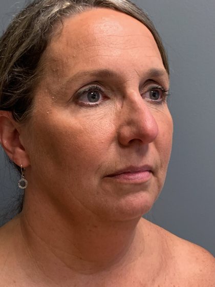 Deep Plane Neck Lift Before & After Patient #6119