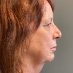 Deep Plane Facelift Before & After Patient #6056