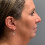 Deep Plane Neck Lift Before & After Patient #6119