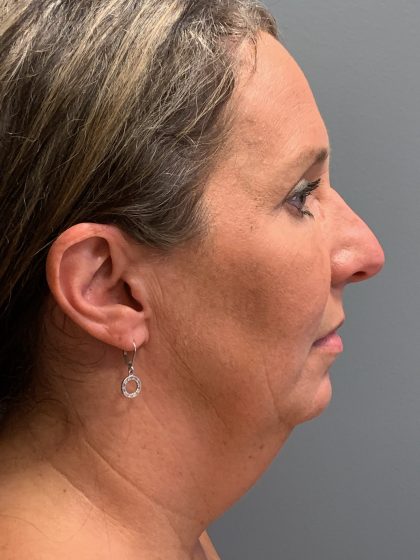 Deep Plane Neck Lift Before & After Patient #6119