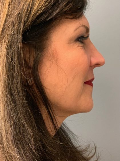 Deep Plane Facelift Before & After Patient #6063