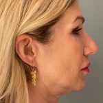 Deep Plane Facelift Before & After Patient #6070