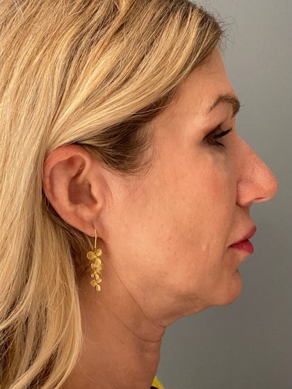 Deep Plane Facelift Before & After Patient #6070