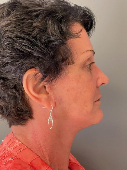 Deep Plane Facelift Before & After Patient #6077