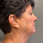 Deep Plane Facelift Before & After Patient #6077