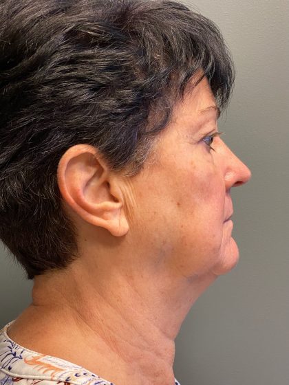 Deep Plane Facelift Before & After Patient #6077