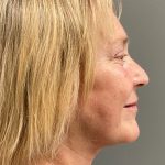 Deep Plane Facelift Before & After Patient #6084