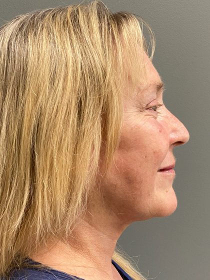 Deep Plane Facelift Before & After Patient #6084