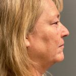 Deep Plane Facelift Before & After Patient #6084