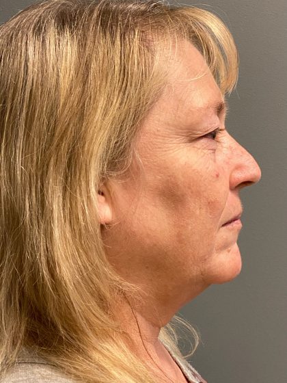 Deep Plane Facelift Before & After Patient #6084