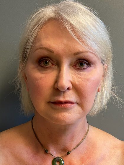 Deep Plane Facelift Before & After Patient #6091