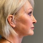 Deep Plane Facelift Before & After Patient #6091