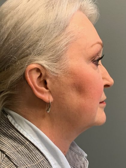 Deep Plane Facelift Before & After Patient #6091