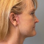 Deep Plane Facelift Before & After Patient #6098