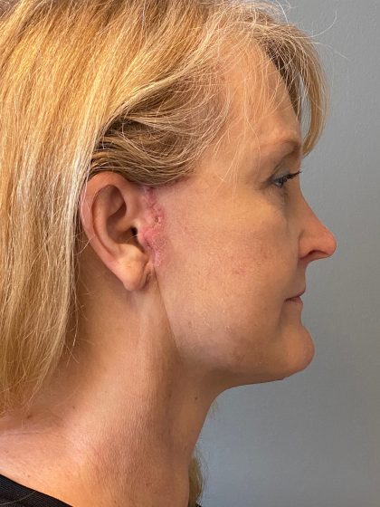 Deep Plane Facelift Before & After Patient #6098