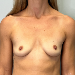 Breast Augmentation Before & After Patient #6013